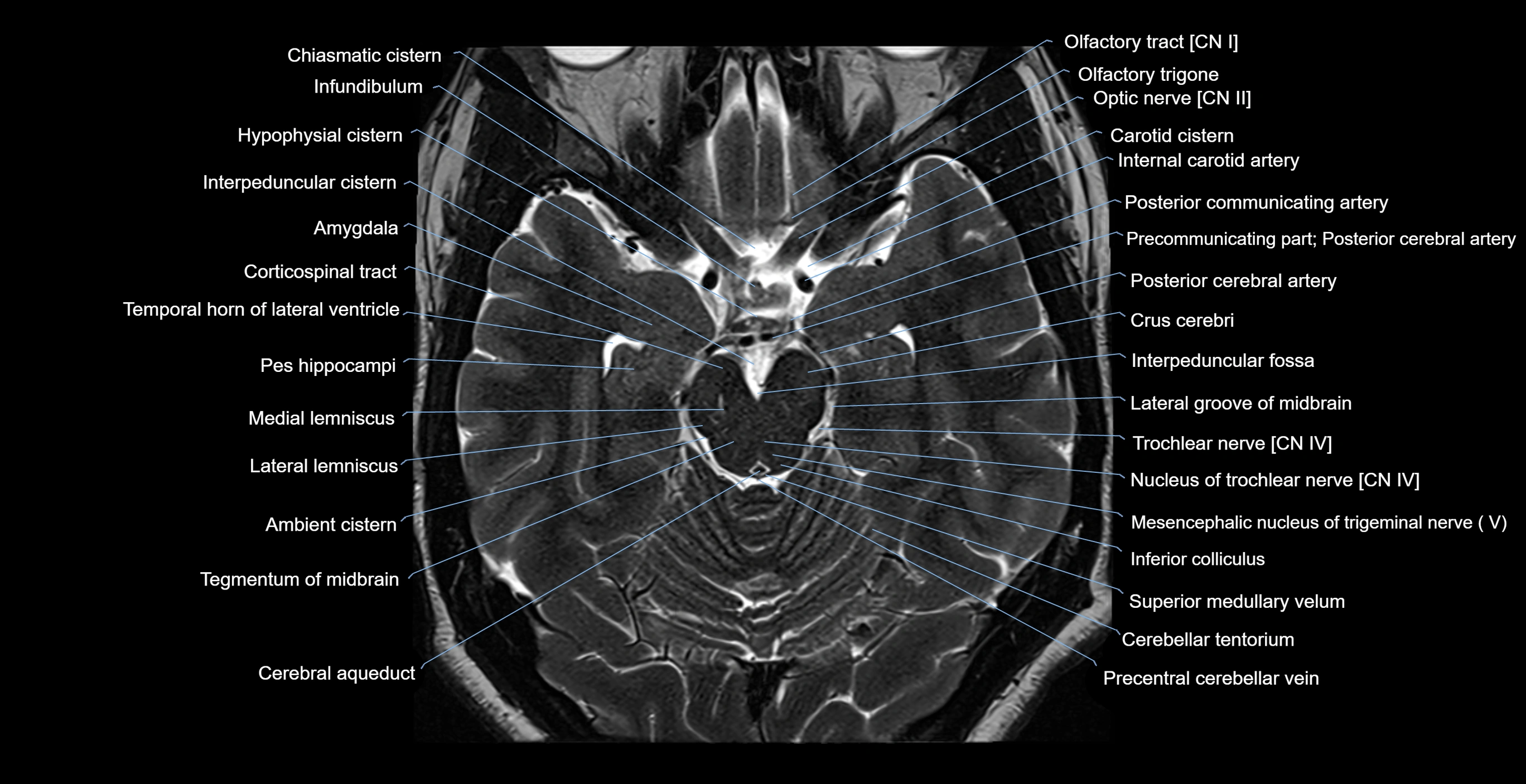 brain axial anatomy 3T MRI images -img-17001-00022.webp
